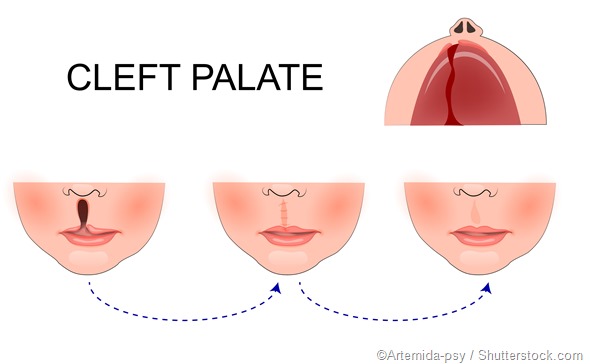 Cleft palate illustration - Artemida-psy 